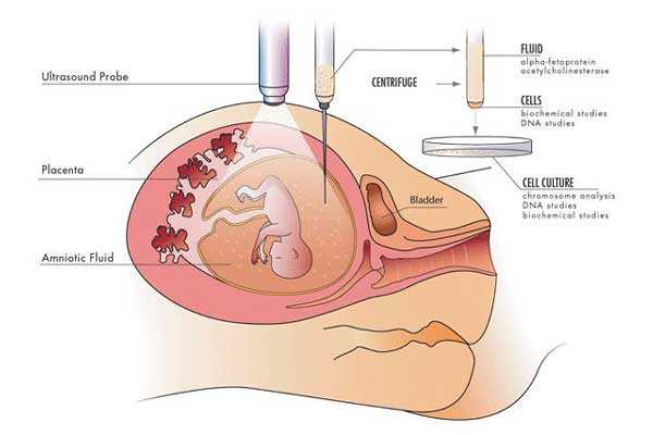 香港7周验血男女费用多少,宫腔积液如何影响辅助生殖技术中助孕过程？